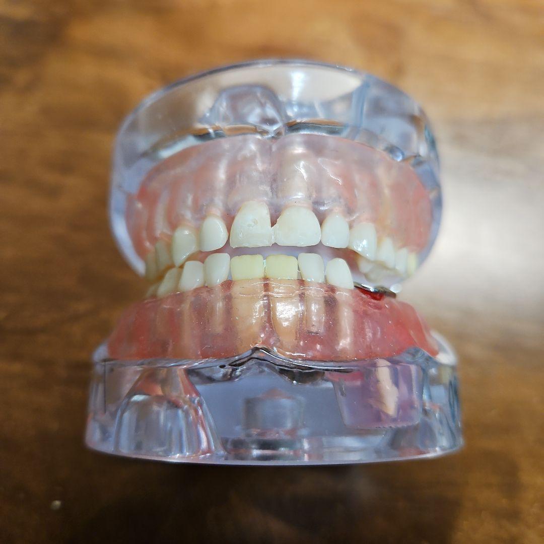 歯科模型 可動式