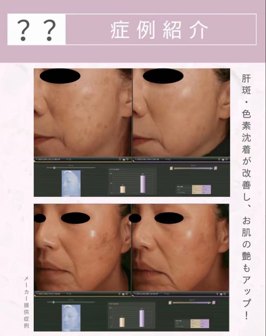 早い者勝嫌がらせ❌美容整形ちゃん♥️　ピンクグロー、レモンボトル