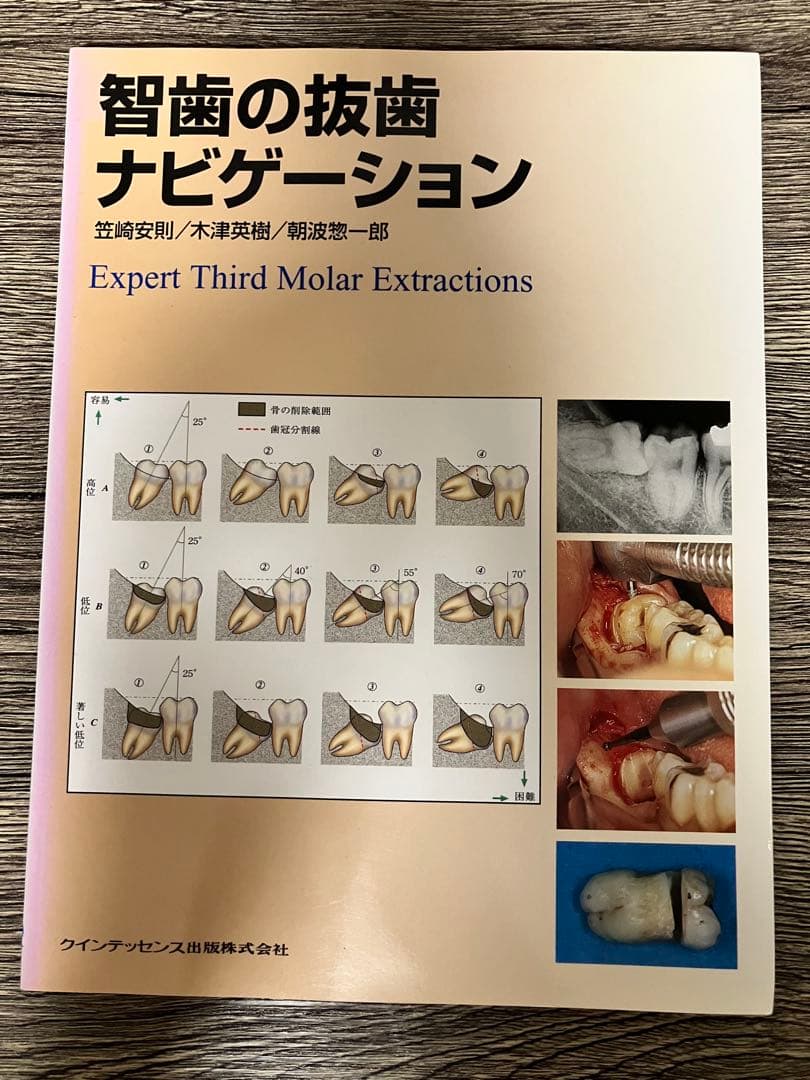 智歯の抜歯ナビゲーション