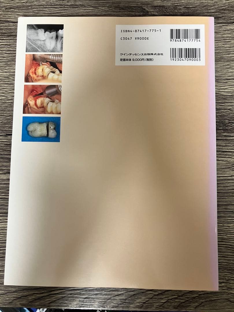 智歯の抜歯ナビゲーション